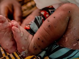 Uma menina de três semanas sofrendo de mpox na sala de emergência do Hospital Kavumu em Kivu do Sul, República Democrática do Congo. (arquivo)