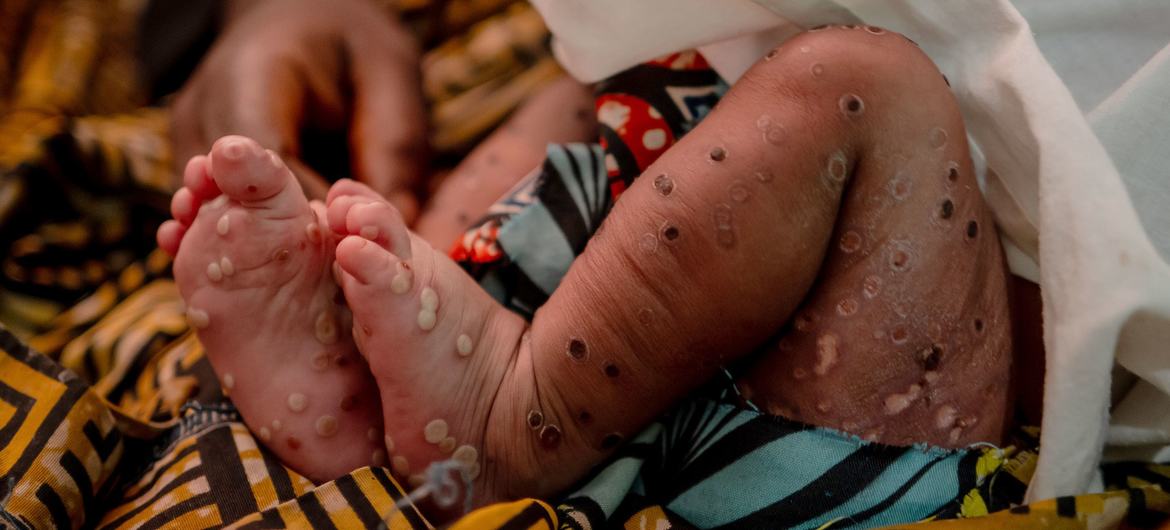 Uma menina de três semanas sofrendo de mpox na sala de emergência do Hospital Kavumu em Kivu do Sul, República Democrática do Congo. (arquivo)