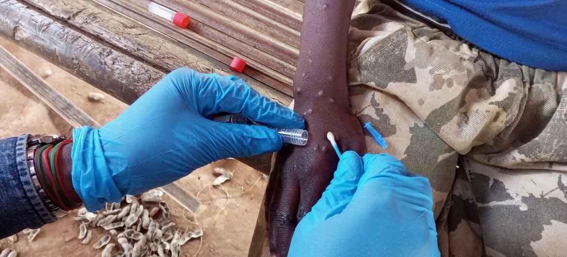 Uma amostra é retirada de uma pessoa com mpox Uma amostra é retirada de uma pessoa com mpox