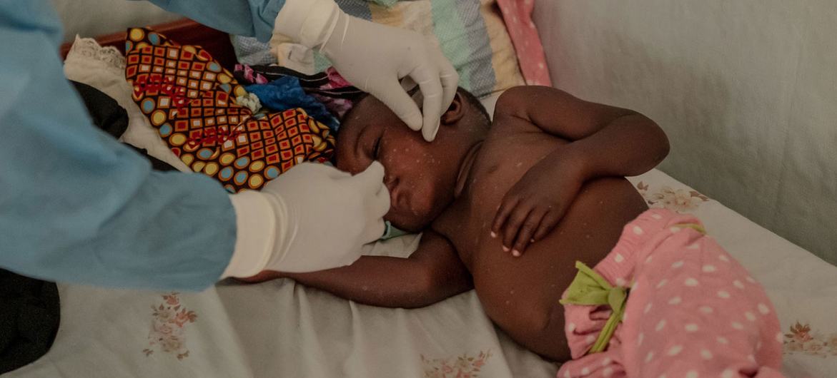 Um profissional de saúde verifica uma criança de dois anos em tratamento para mpox ao norte de Goma, República Democrática do Congo Um profissional de saúde verifica uma criança de dois anos em tratamento para mpox ao norte de Goma, República Democrática do Congo