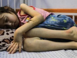 Uma criança sofrendo de desnutrição acompanhada no  Hospital da Sociedade de Pacientes na Cidade de Gaza