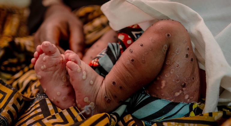 Bebê como Mpox Bebê como Mpox