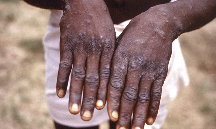 variola-dos-macacos-2